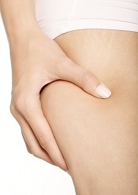 La celulitis es cuestión de estética y vanidad, pero también es un indicador de buena salud